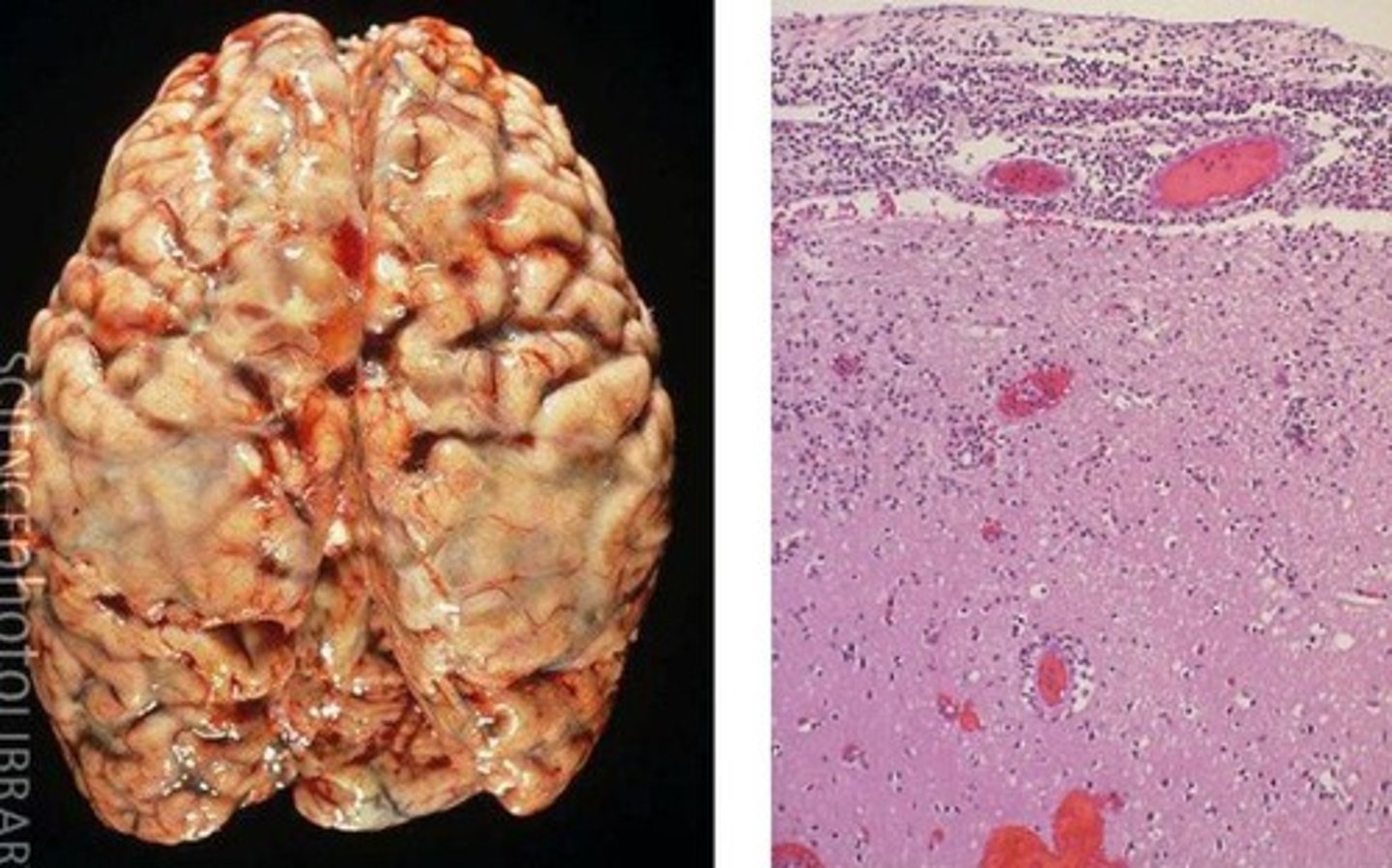 <p>inflammation of the meninges of the brain and spinal cord</p><p>- viral or bacterial</p><p>- pus on brain (bacterial)</p>