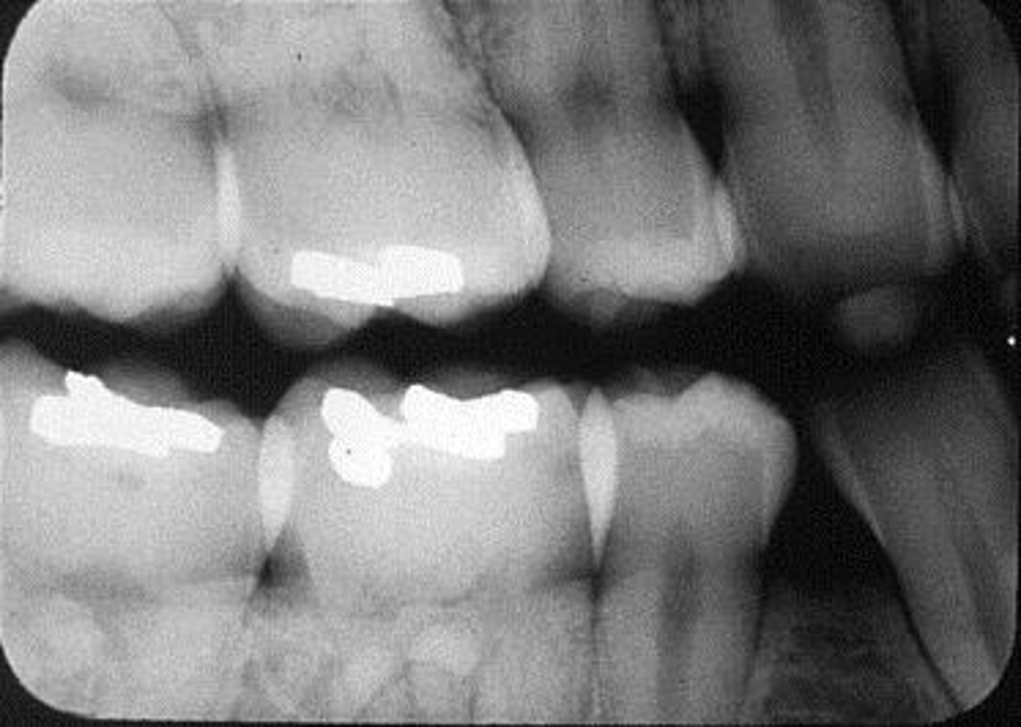 <p>Appearance-Overlapped contacts or roots</p><p>Cause-Plane of plate not parallel to long axis of teeth. Central ray was not directed through inter proximal spaces.</p><p>Correction-Position plate parallel to the teeth. Direct x-ray beam through interproximal regions</p>