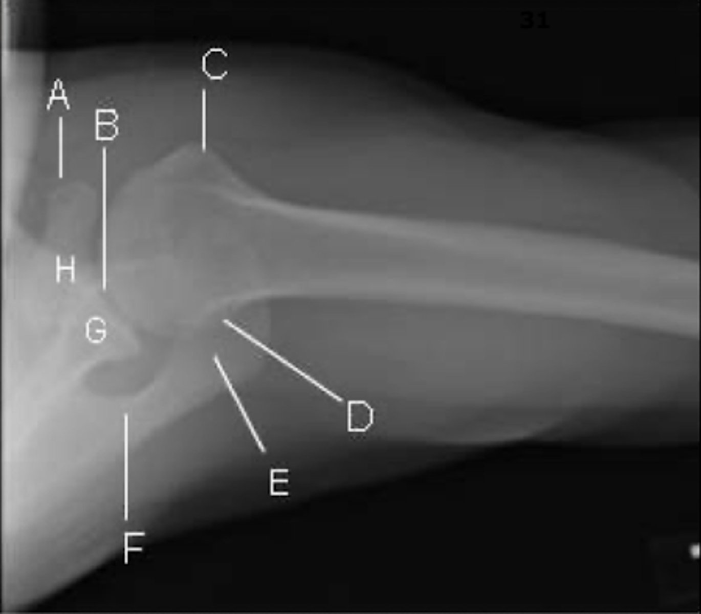 <p>A → coracoid process</p><p>B → glenohumeral joint</p><p>C → less tubercle</p><p>- externally rotated so will look more anterior</p><p>D → posterolateral humeral head</p><p>E → acromion</p><p>F → spine of the scapula</p><p>G → glenoid process</p><p>H → base of the coracoid</p>