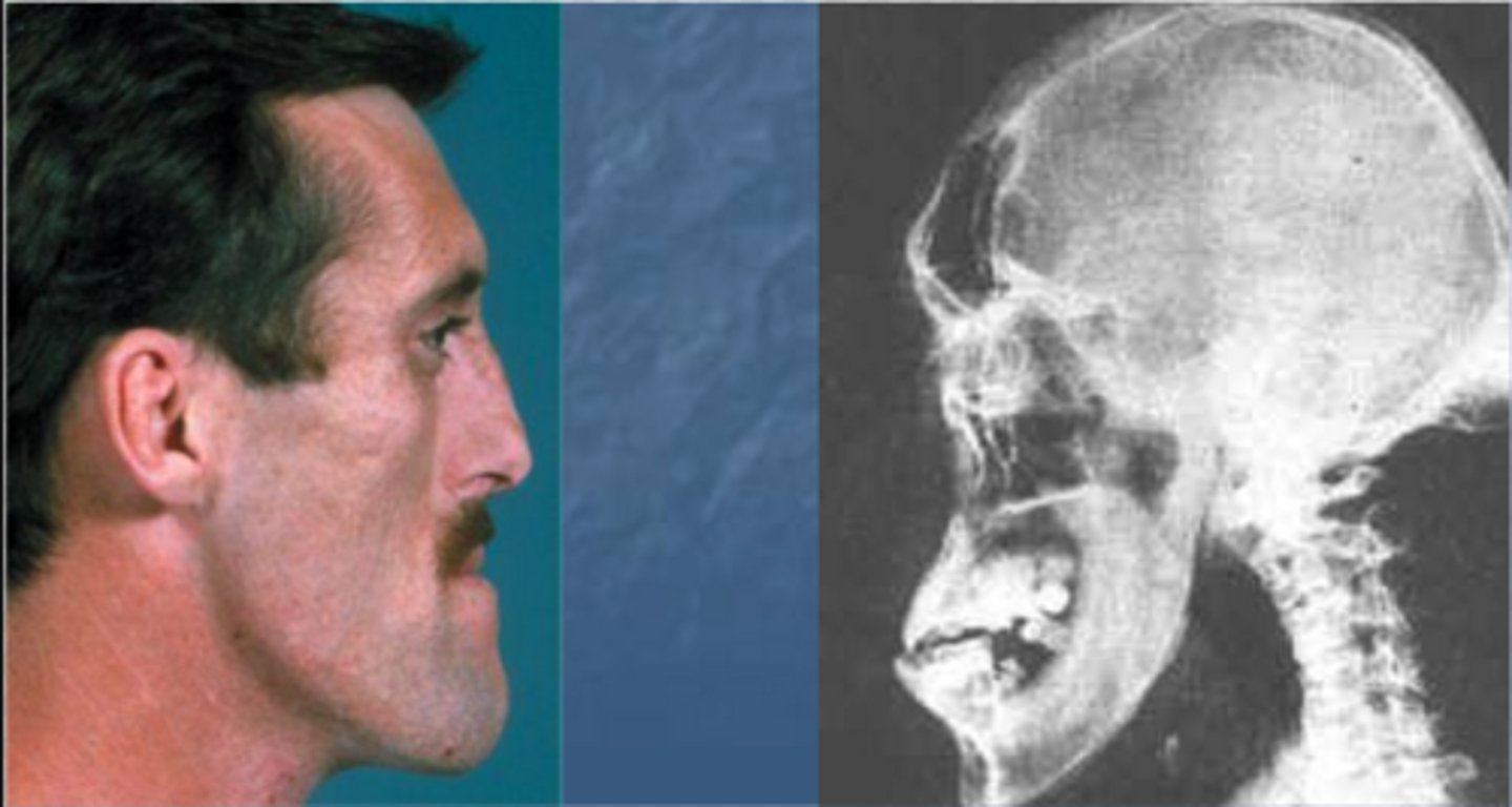 <p>enlargement of the extremities caused by excessive secretion of growth hormone after puberty</p>