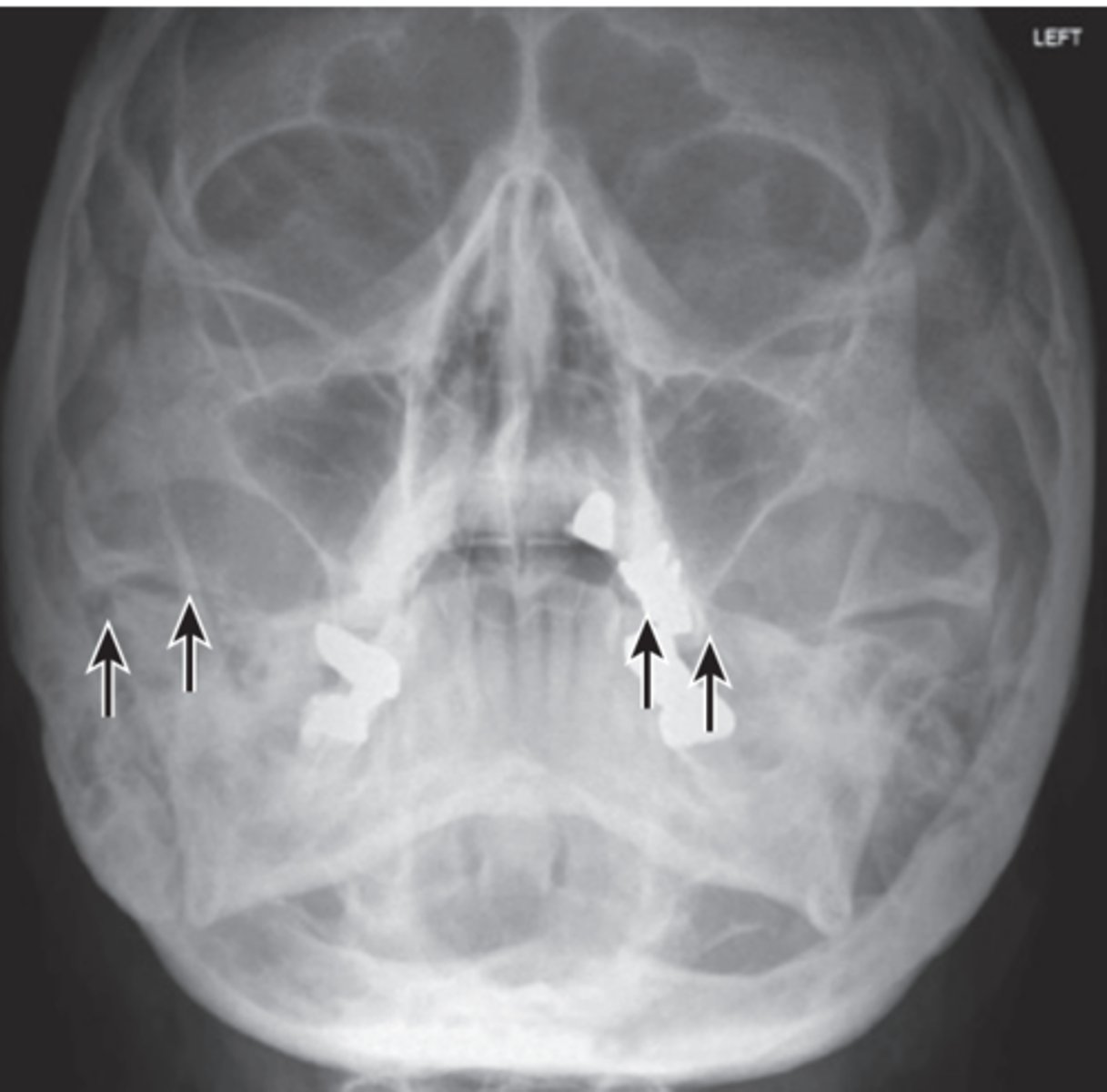 <p>-Position:</p><p>• Correct neck extension demonstrates petrous ridges just inferior to the maxillary sinuses</p><p>• No patient rotation exists, as indicated by equal distance from the midlateral orbital margin to the lateral cortex of cranium on each side.</p>