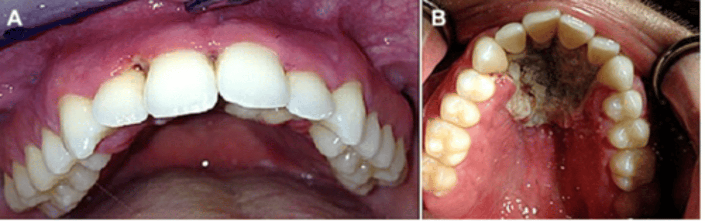 <p>Progression of NP into tissue beyond the mucogingival junction characterizes necrotizing stomatitis - mostly in malnutrition and HIV infection - may result in denudation of the bone leading to osteitis and oro-antral fistulas</p>