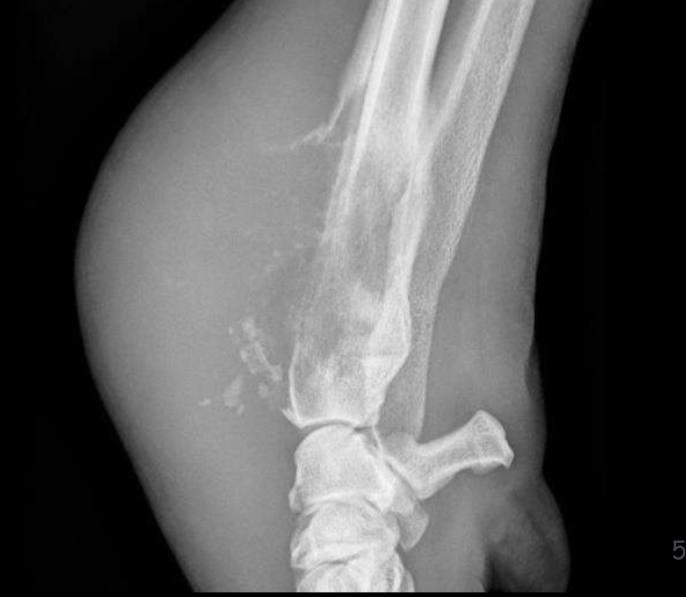 <p>What type of periosteal reaction</p>