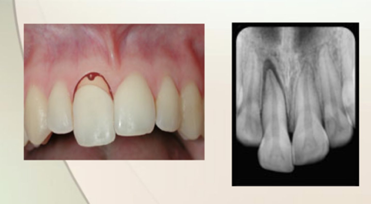 <p>partial displacement of the tooth out the socket</p>