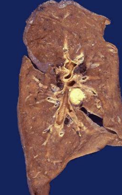 <p>Caseous Necrosis</p>