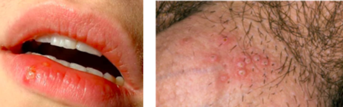 <p>Viral ID:</p><p>Overview:</p><p>- Primarily spread by skin-to-skin contact</p><p>- Treatable but not curable</p><p>2 types: (treated similarly, just differs in location/how common they occur)</p><p>Type 1 </p><p>- Mostly spreads by oral contact and causes infections in/around the mouth (cold sores)</p><p>- Can also cause genital herpes</p><p>Type 2</p><p>- Spread by sexual contact and causes genital herpes</p>