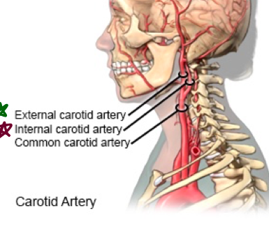 main arteries of the head and neck are the L/R common carotid arteries 

\
Common carotid artery ascends within the carotid sheath to the carotid triangle where it splits into 2 braches:


1. Internal carotid artery - Internal carotid artery has no branches in the neck. Enters the skill through the carotid canal (in temporal bone) to supply blood to the brain, no branches.
2. External carotid artery - Supply everything on inside of head. The external carotid artery is the main source of blood to structures of the neck, face, and scalp. (structures external to the skull) 

   \
