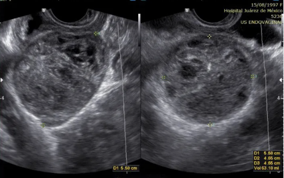 <p>a 19 yo has intermittent pelvic pain on the left side + abn menstrual cycles. </p><p>.</p><p>she has <strong>no recent sexual activity</strong>, but her LMP was 10 weeks ago. she has a recent <strong><u>positive home pregnancy test</u></strong>. </p><p>.</p><p>the US shows a <strong>solid mass</strong> w/<strong>cystic degeneration</strong> on the left ovary</p><p>.</p><p>a) mucinous cystadenocarcinoma</p><p>b) serous cystadenocarcinoma</p><p>c) krukenberg tumor</p><p>d) choriocarcinoma</p>