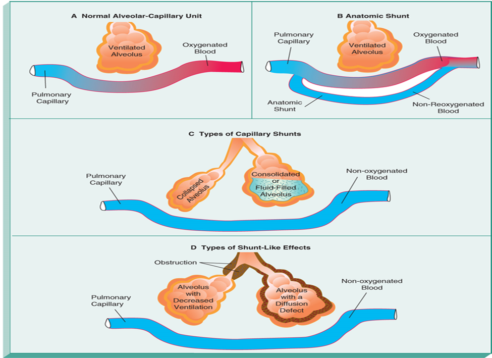 <p>Anatomic</p><ul><li><p> exist when blood flows from right side of heart to left side without coming in contact with alveolus for gas exchange </p></li></ul><p>Capillary </p><ul><li><p> caused by alveolar collapse or atelectasis, alveolar fluid accumulation, alveolar consolidation </p></li></ul><p></p>
