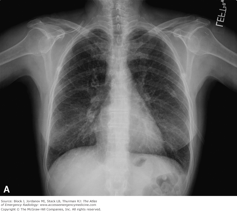 <ul><li><p><span style="background-color: transparent;"><span>Four Key Findings in Pulmonary Interstitial Edema:</span></span></p><ul><li><p><span style="background-color: transparent;"><span>Thickening of the interlobular septa—Kerley B lines—and fluid in the central connective tissue of the lungs—Kerley A lines</span></span></p></li><li><p><span style="background-color: transparent;"><span>Peribronchial cuffing: fluid-thickened bronchial walls visualized on-end</span></span></p></li><li><p><span style="background-color: transparent;"><span>Fluid in the fissures: opacification and thickening of the interlobar fissures</span></span></p></li><li><p><span style="background-color: transparent;"><span>Pleural effusion: usually bilateral but, when unilateral, usually right-sided</span></span></p></li></ul></li></ul><p></p>