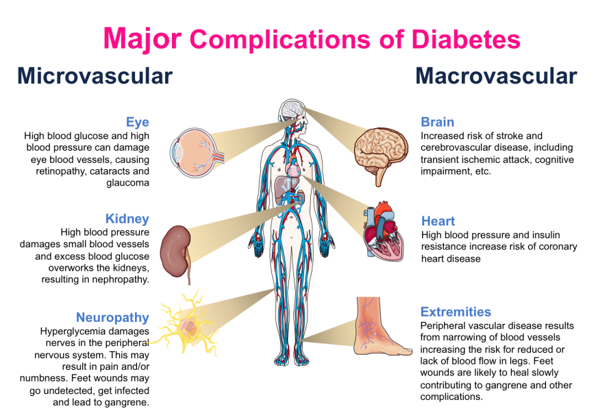 <p>B) Diabetic retinopathy - Retinopathy is a microvascular complication affecting small retinal vessels.</p>