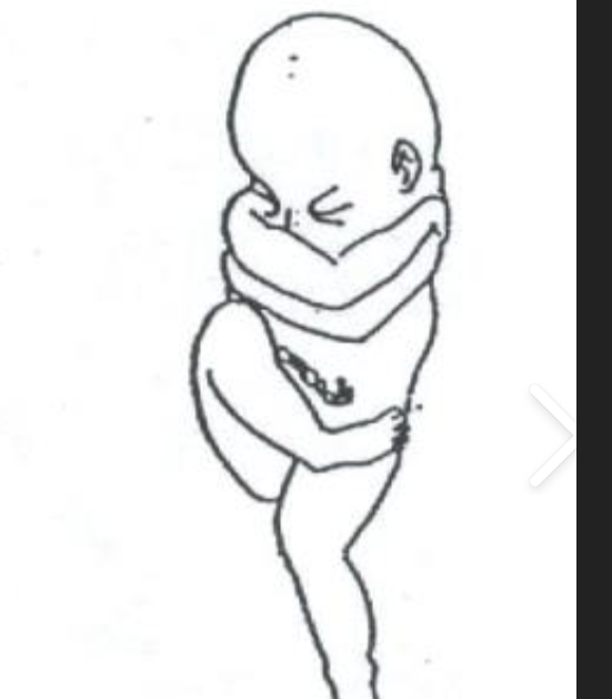 <p>c/s required; one or both <strong>hips and knees extended</strong>; <strong>single or both feet present first</strong>; high risk for cord prolapse and fetal injury</p>