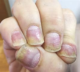 <p>sharply defined pitting and crumbling of nails with distal detachment </p><ul><li><p>occurs with psoriasis, PVD, and TB</p></li></ul>