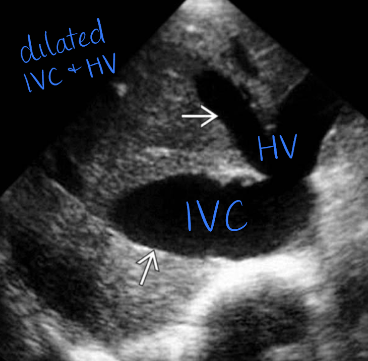 <ul><li><p>right ventricular failure (causes IVC to not collapse during inspiration or expiration)</p></li><li><p>IVC and HV dilation</p></li><li><p>compression from pregnancy —> edema of feet and ankles and varicose veins</p></li><li><p>tumor or thrombus (heterogeneous mass looks the same in gray-scale, so use color Doppler)</p></li></ul><p></p>