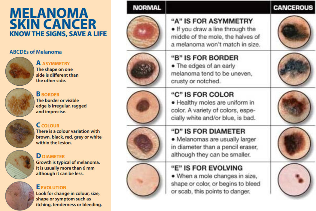 <p>what do the ABCDEs of Hyperpigmented Lesions (freckles) stand for</p>