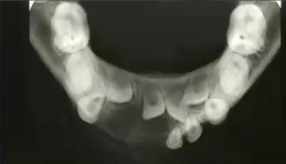 <p>occurs before 30 years old and <strong>crosses midline</strong>, diagnosis? </p>