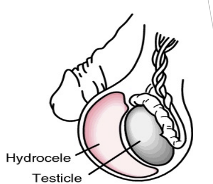 <p>Scrotal contusion</p>