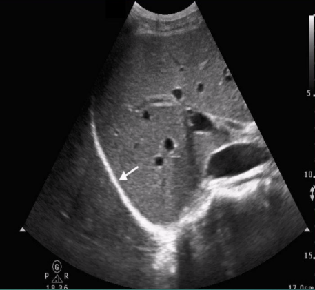 <ul><li><p>double domed, musculotendinous partition separating the thoracic cavity from the abdominal cavity</p></li><li><p>“parachute”-shaped</p></li></ul><p></p>
