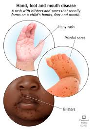 <p>E: coxsackie virus<br>common<br>mild<br>short-lasting</p><p>contagious:<br>direct contact<br>nasal<br>oral secretions<br>fecal contamination</p><p>CM: flat pink patches→blisters on hands+feet<br>peel off in a week<br>small+painful vesicles in mouth<br>red macules+papules on butt/arms/genitals</p><p>TX:<br>don’t pop blisters<br>antiseptic mouthwash<br>maintain fluid intake<br>poor PO→IV fluids<br>painful oral ulcer→topical/PO analgesics</p>