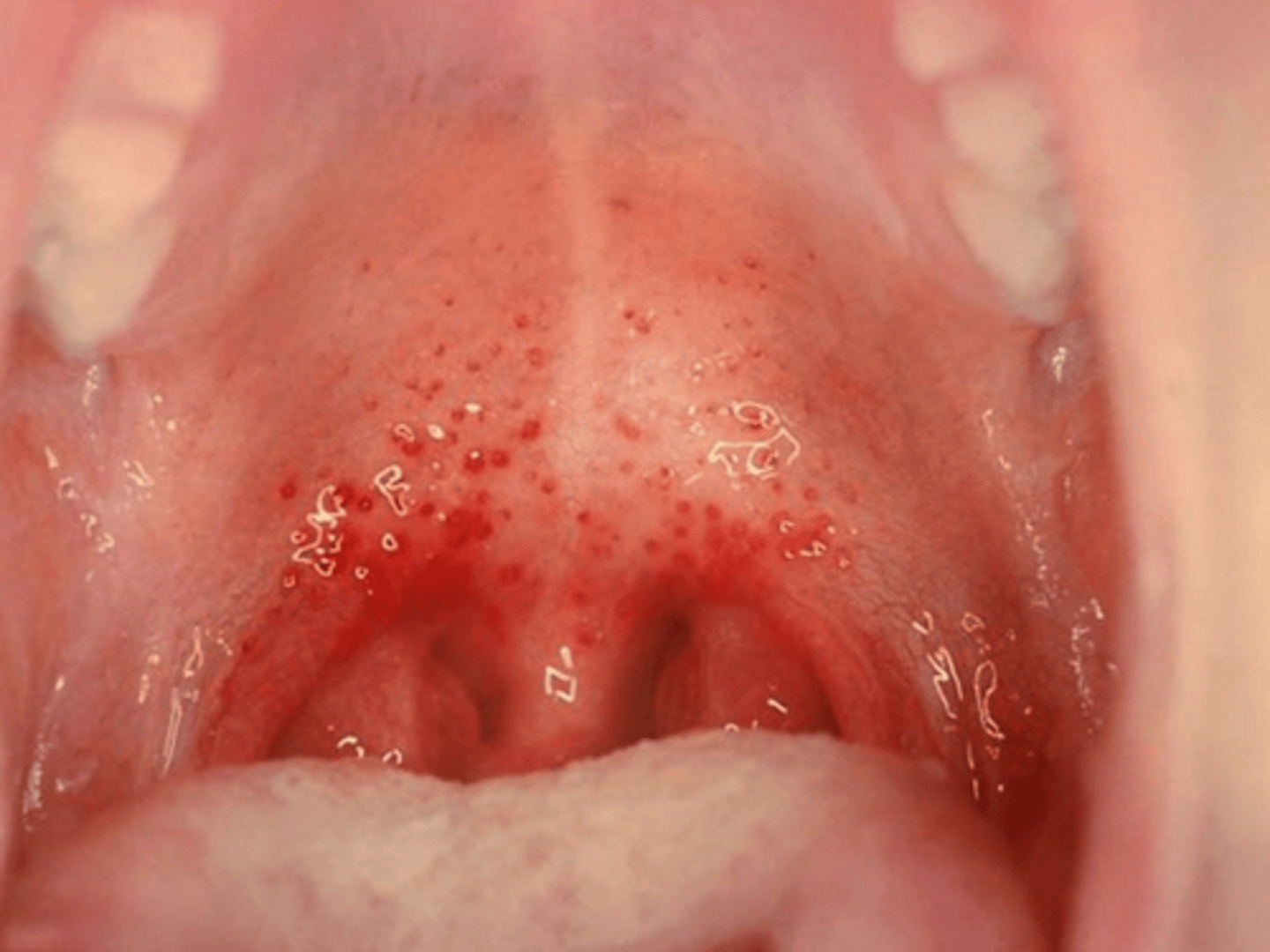 <p>red macules/petechiae on soft palate → associated with rubella (german measles)</p>