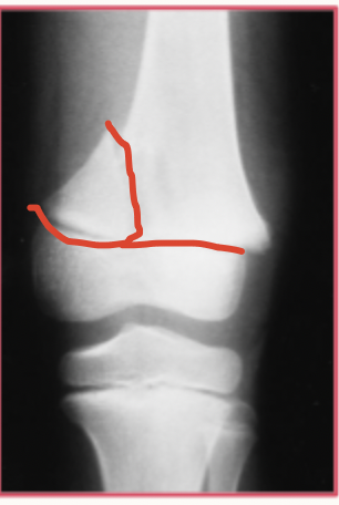 <p>6 y/o girl presents to the ED for leg pain following a fall down the stairs at school. On physical exam you note knee swelling which is tender to palpation. She is unable to bear weight of the leg due to pain. What is your treatment plan?</p>