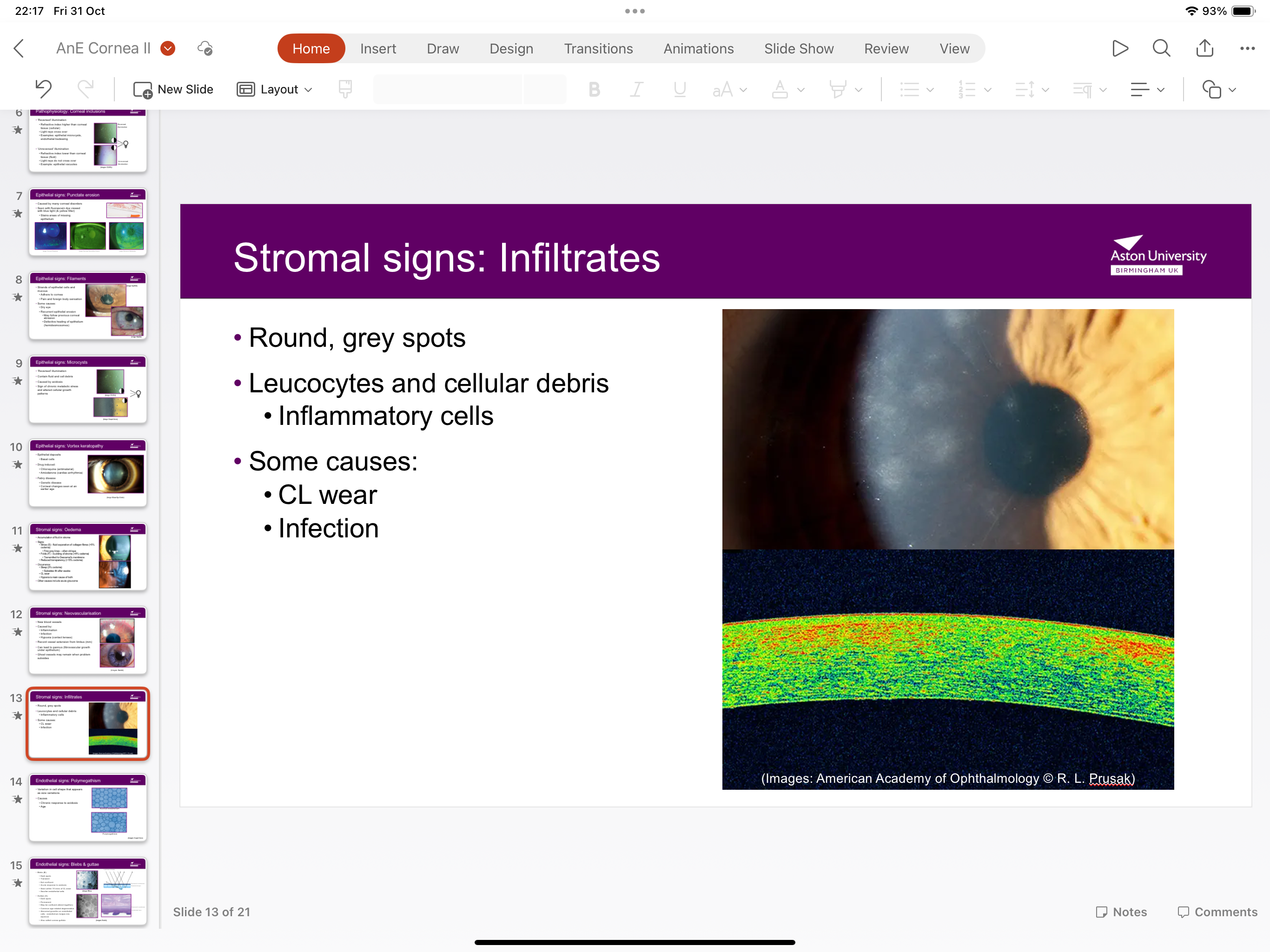 <p>Round grey spots caused by leukocytes and cellular debris- caused by contact lenses wear and infection</p>