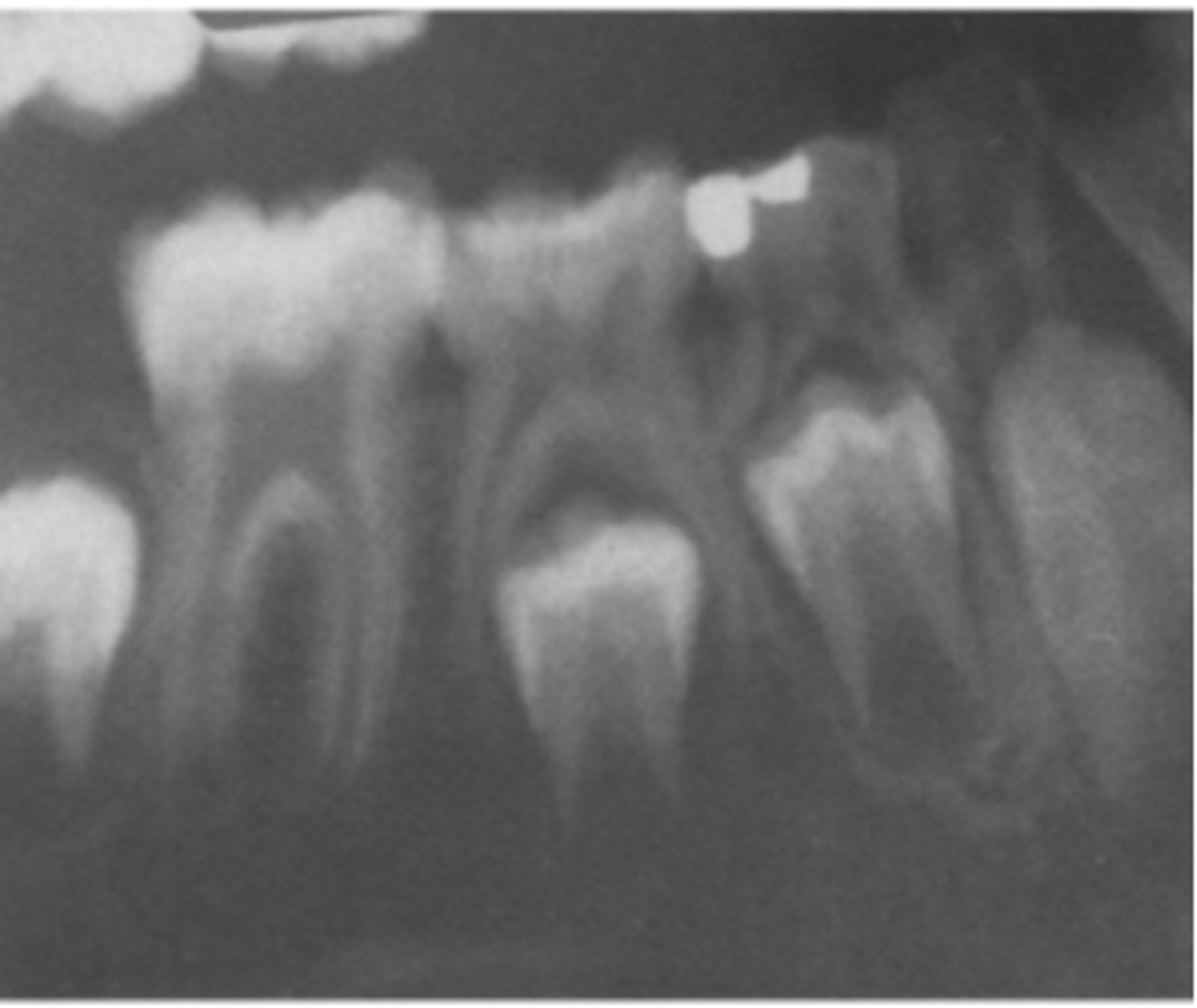 <p>hypomineralization of teeth:</p><p>-large pulp chambers of primary teeth</p><p>-pulp horns extend to DEJ</p><p>-taurodont-type pulp chamber</p>