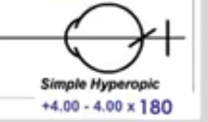 <p>simple hyperopic astigmatism</p>