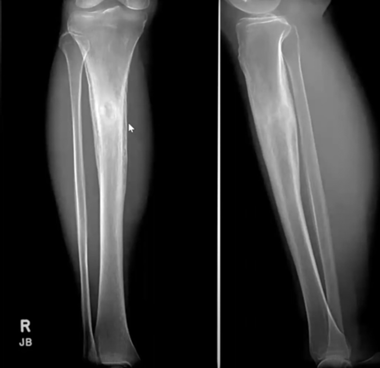 <p>What is this?</p><p>Ex. Local limb pain, relieved with aspirin</p>