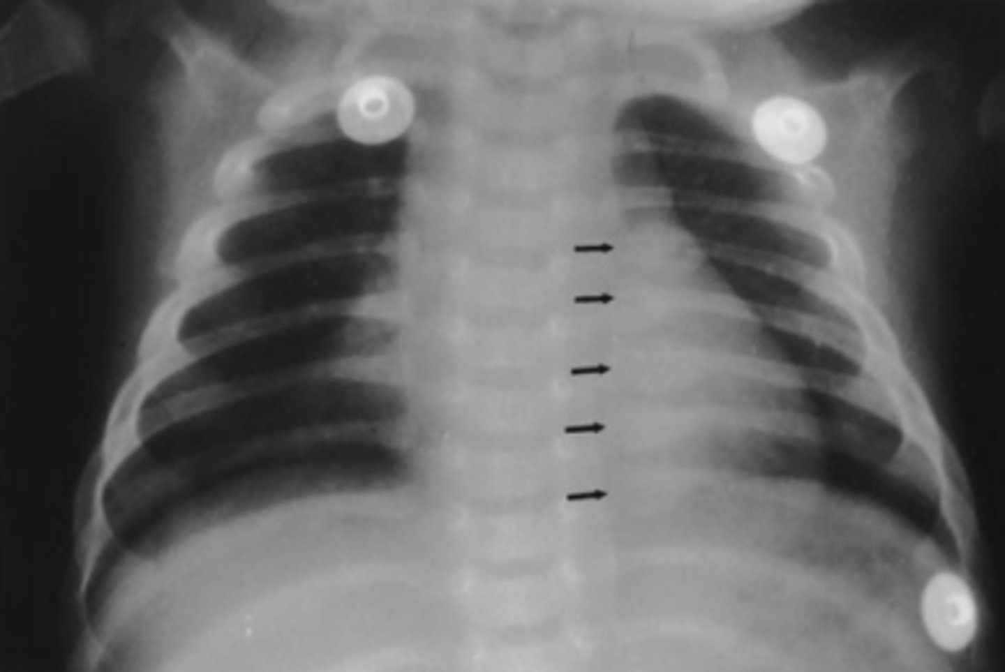 <p>You interpret the chest radiograph for Case 6-2</p><p>(Figure 6-9) and render the following opinion:</p><p>A. Normal chest radiograph</p><p>B. Round pneumonia</p><p>C. Healing rib fractures</p><p>D. Pneumothorax</p>