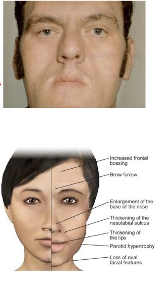 <p>Excess GH:</p><ul><li><p>What physical characteristics occur for people w Excessive GH? (6)</p></li></ul><p></p><p></p>