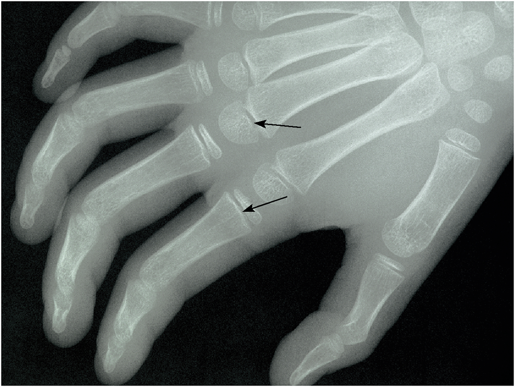 why is the epiphyseal plate important?
