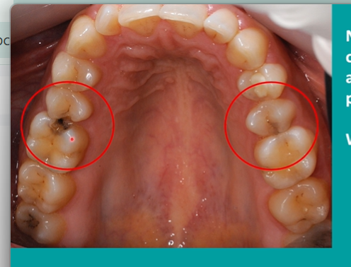 <p>in the black - areas within the lesion there are still areas of remineralisation </p>