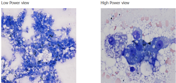 <p>Liver cytology shows these highly cellular samples containing highly vacuolated hepatocytes and extracellular bile casts. Based on the lab results and cytology findings, name 2 differentials to consider</p>