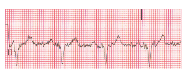 <p>EKG artifact usually caused by patient tremors or shivering.</p>