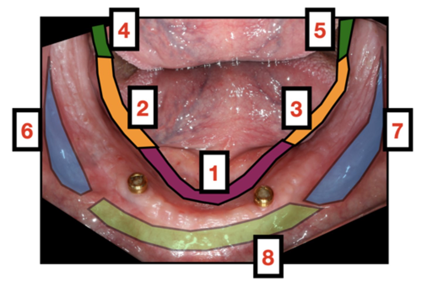 <p>1- The sublingual crescent area</p><p>2- The mylohyoid area (one side then theother)</p><p>3- Retromylohyoid area (one side then theother)</p><p>4- Buccal vestibule (one side then theother)</p><p>5- Labial vestibule</p>