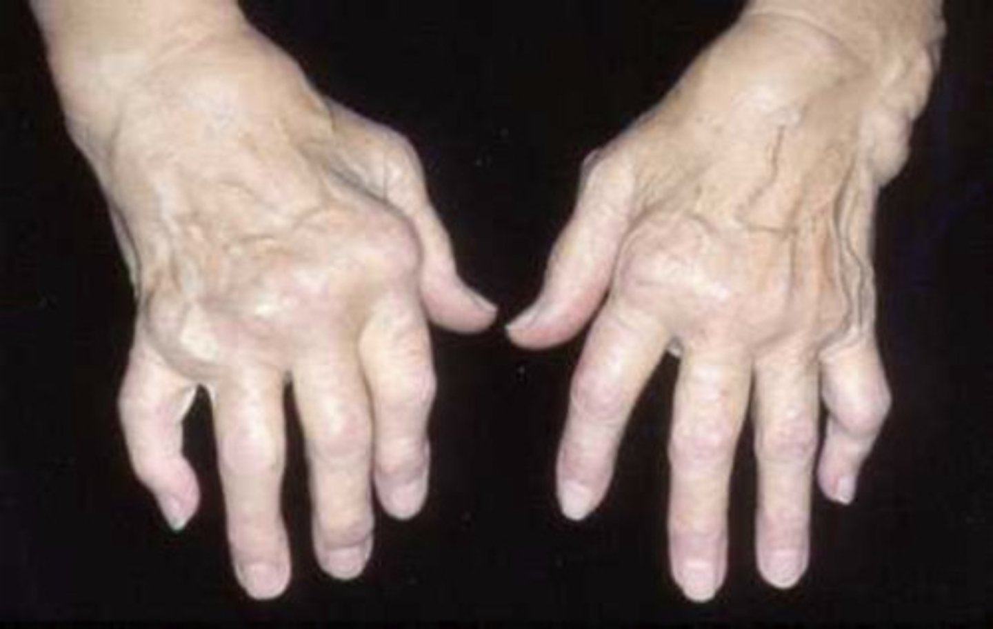 <p>(n) a painful condition involving the joints and muscles; pain characterized by inflammation</p>