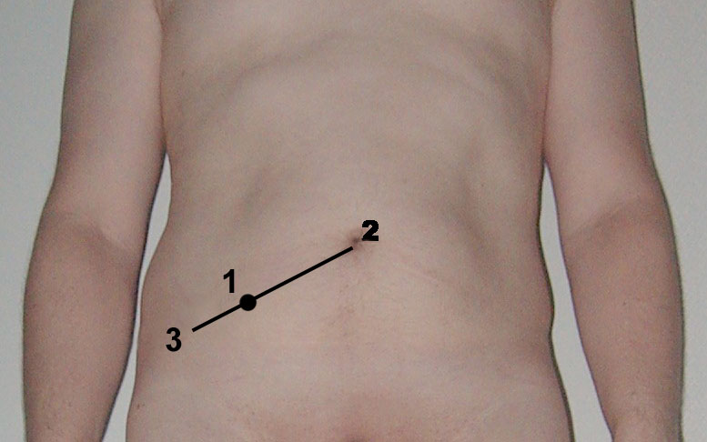 A pain in the chest or abdominal area that’s elicited by applying gentle but steadily increasing pressure over McBurney’s point below the right anterior superioir spine of the ilium, on a line between that spine and the umbilicus