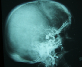 <p>what kind go aneurysm </p>