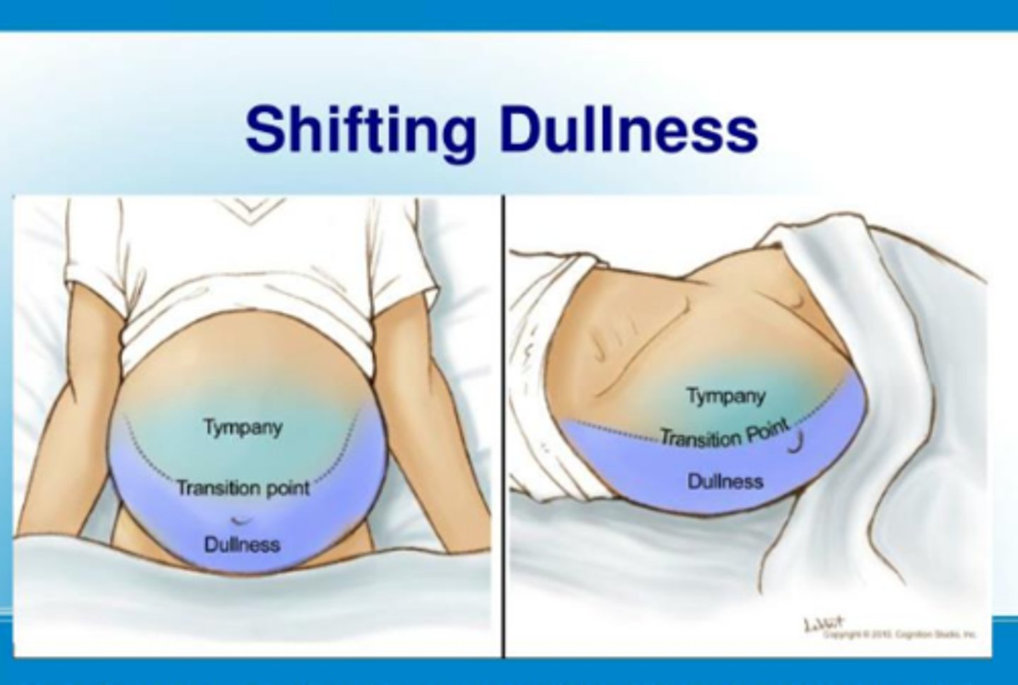 <p>testing for shifting dullness</p><p>- after mapping out the areas of tympany and dullness, have the patient roll to one side. Remap the areas of tympany and dullness. In ascites there should be a shift due to free fluid moving with gravity</p>