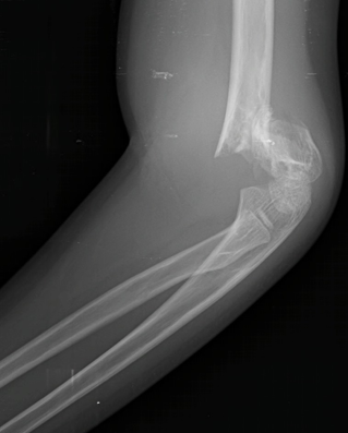 <p>complications w/ Supracondylar Ridge Fracture include Non/Malunion → Cubitus Varus; additionally</p>