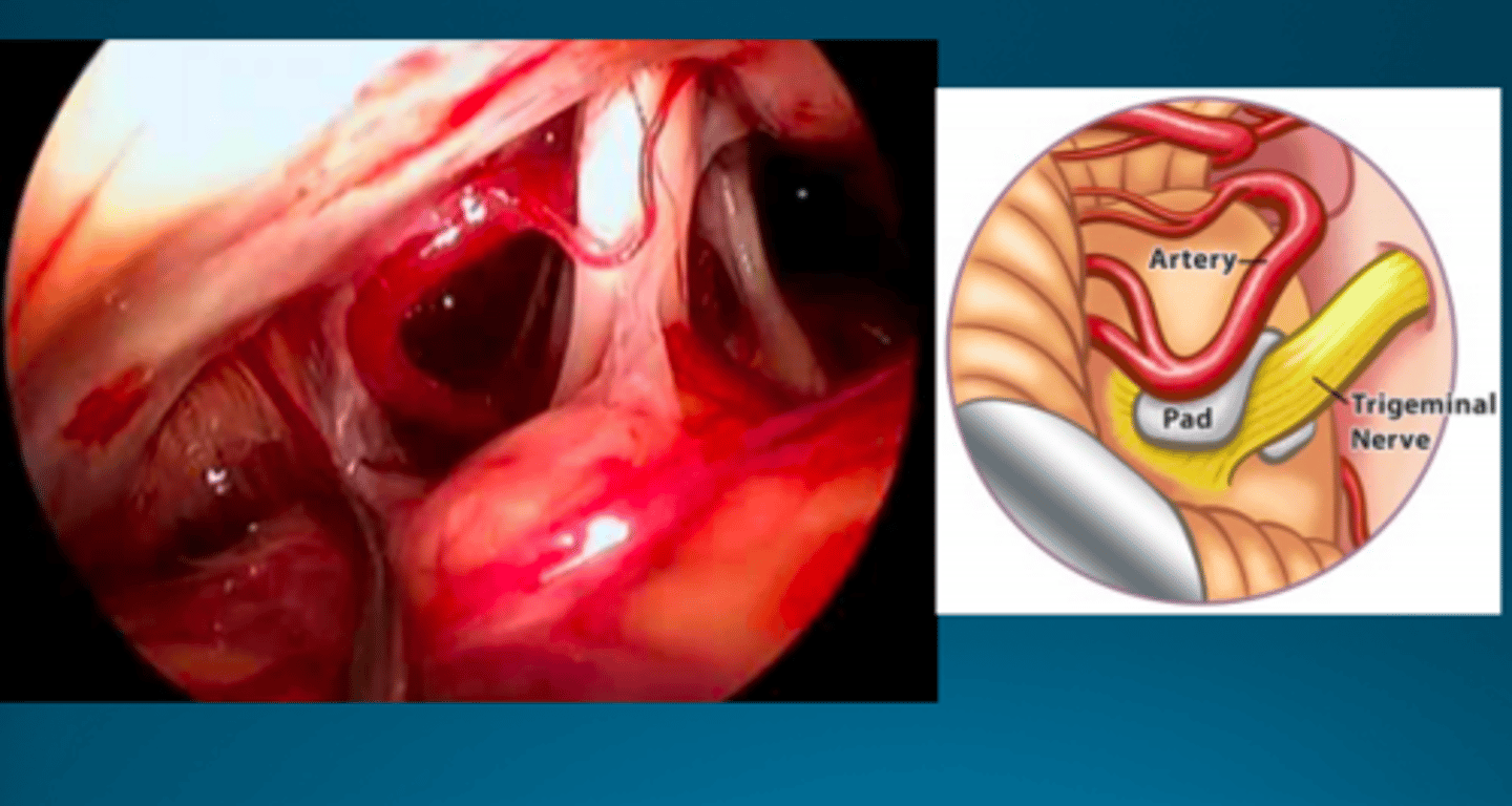 <p>suboccipital craniotomy approach performed to remove abnormal compression of a cranial nerve by an artery near the brainstem --&gt; retraction on cerebellum &amp; brainstem</p>