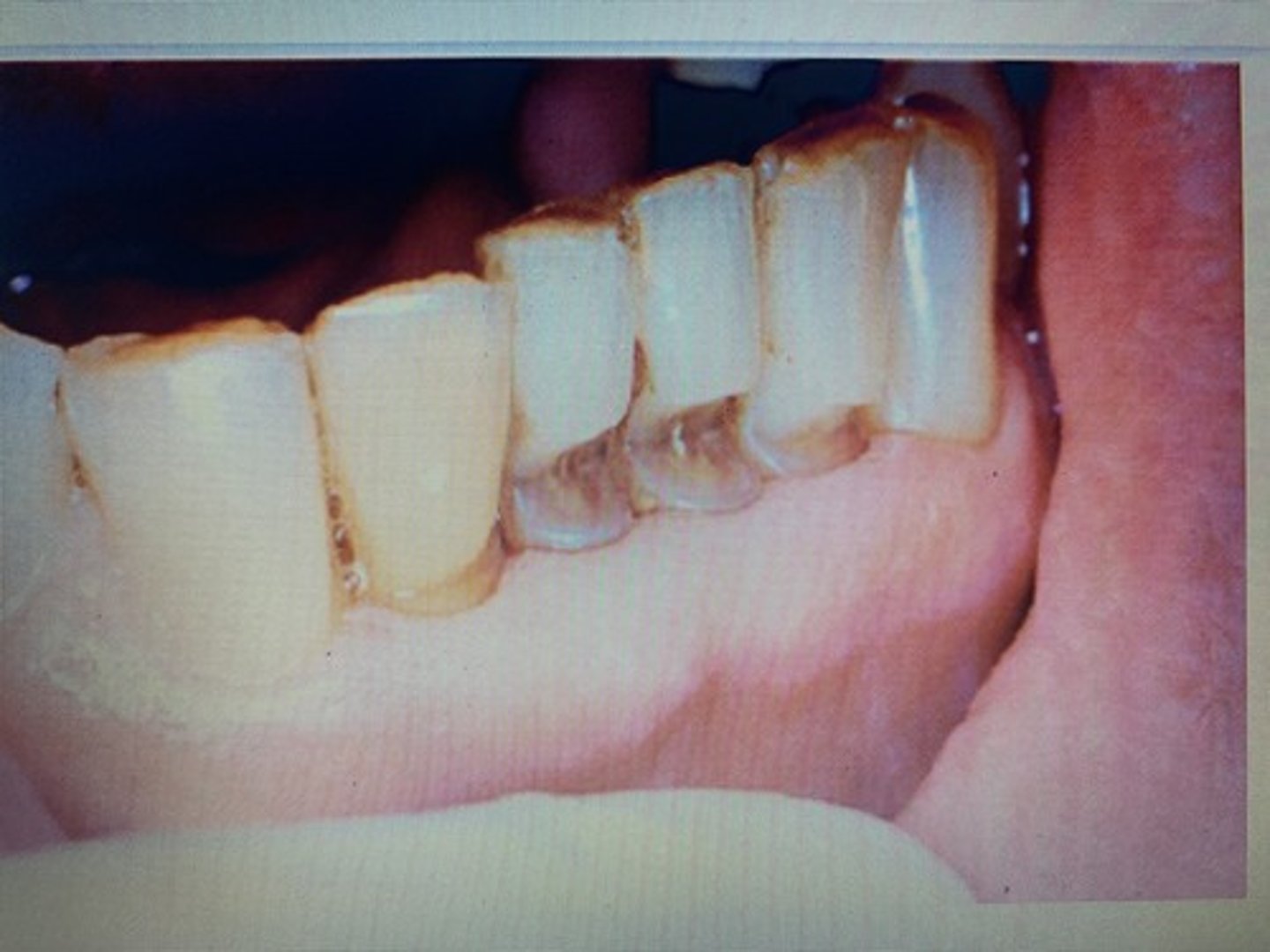 <p>Abfraction ( wedge shaped defects at the gum line caused by micro fractures in the tooth structure. Often worsened by clenching, grinding, extremely hard brushing, or biting objects such as fishing line etc.)</p>