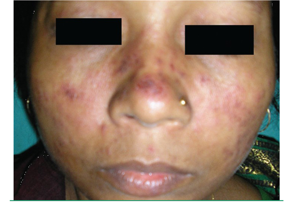 <p>chronic autoimmune dz that encompasses a wide range of dermatologic manifestations and may or may not be assoc. w/ systemic dz</p>