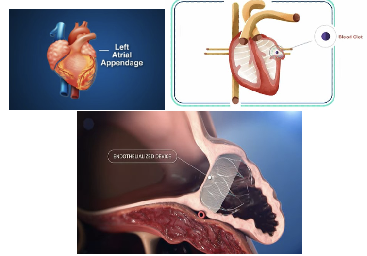 <ul><li><p>90% of clots are formed by a-fib that originate in the LAA.</p></li><li><p>An endothelialized device is placed inside of that area and keeps/catches clots from getting out into the heart and the rest of the body.</p></li></ul><p></p>