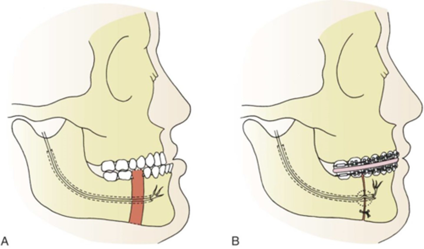 <p>- involves a section of the lower jaw's body being surgically removed to correct deformities like a jaw that sticks out too far.</p><p>- often performed using a transoral (intraoral) approach, aims to preserve the inferior alveolar nerve, which is freed and mobilized before the bone is cut and the segments are repositioned and secured.</p><p>- done through a single-stage or two-stage approach, with the latter involving both intraoral and extraoral components.</p>