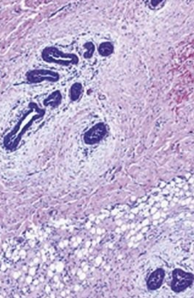 A 22-year-old man has had bilateral breast enlargement for the past 5 years. The microscopic appearance of his breast tissue is shown. This lesion and the tissue shown on Side A represent estrogen effects on breast epithelium. What is the difference between the effects seen in male breasts versus female breasts? Why might this man have elevated estrogen levels?  
