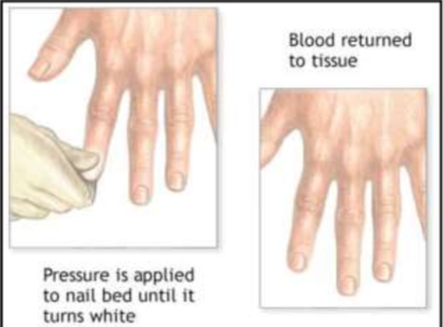 <p>capillary refill</p><p></p>