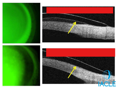 <p>Label:</p><p>_____________ limbal clearance</p>