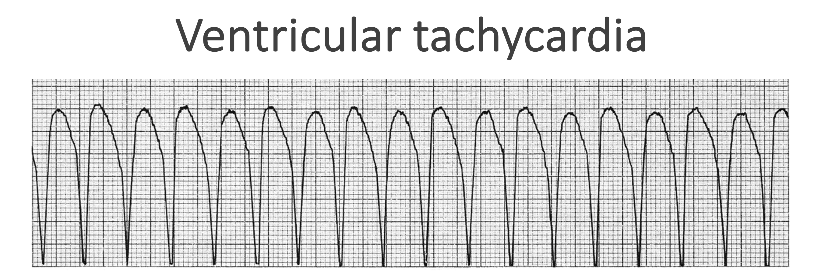 <p>Ventricular tachycardia</p>